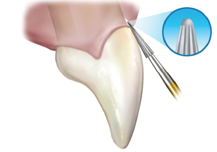 Finishing at the gingiva